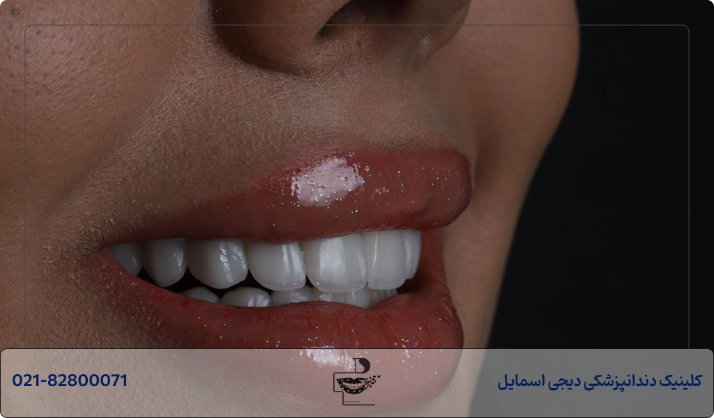 چگونه طول عمر کامپوزیت دندان ها را زیاد کنیم؟