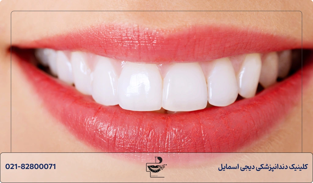 مزایای کامپوزیت دندان در شمال تهران
