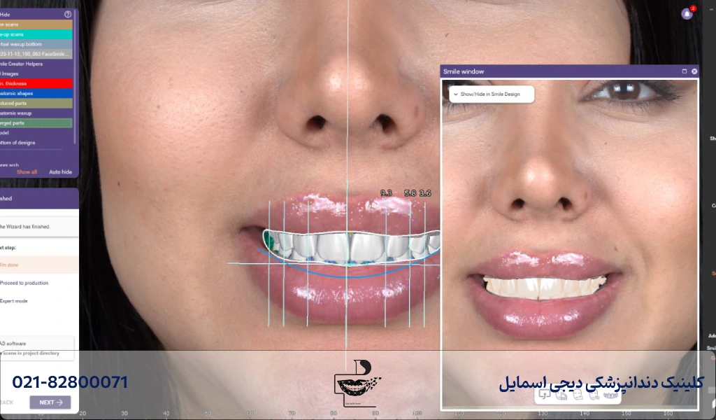 مزایا و عوارض کامپوزیت دیجیتال