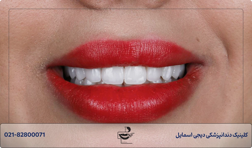 کامپوزیت دندان در شمال تهران در بهترین مرکز زعفرانیه