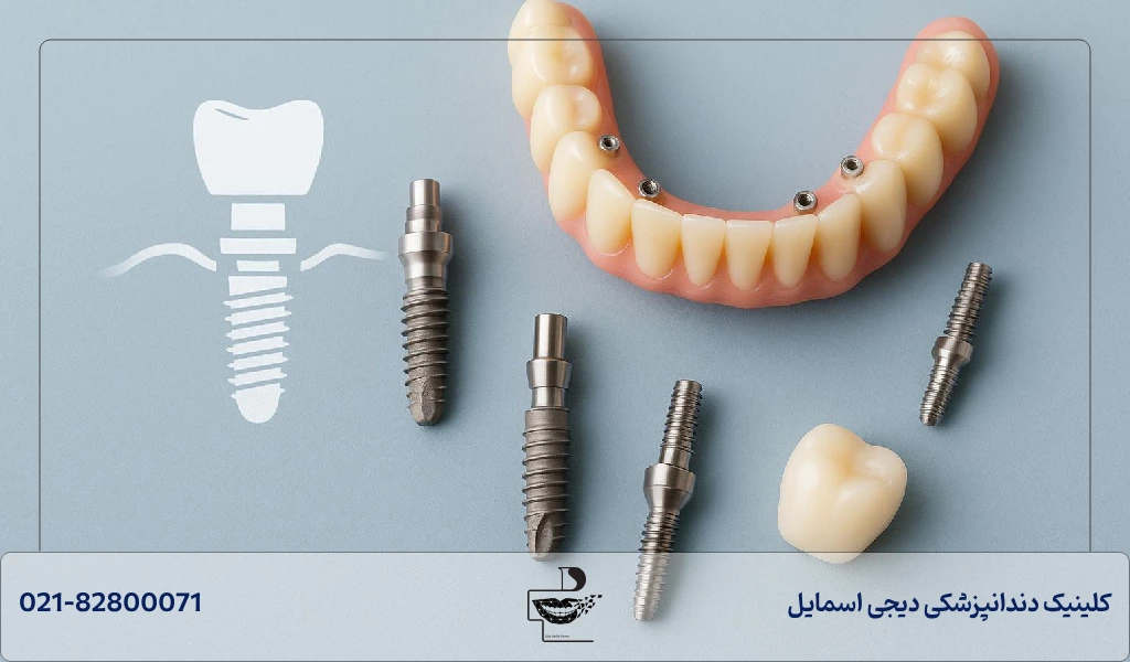عمر ایمپلنت دندان چقدر است؟