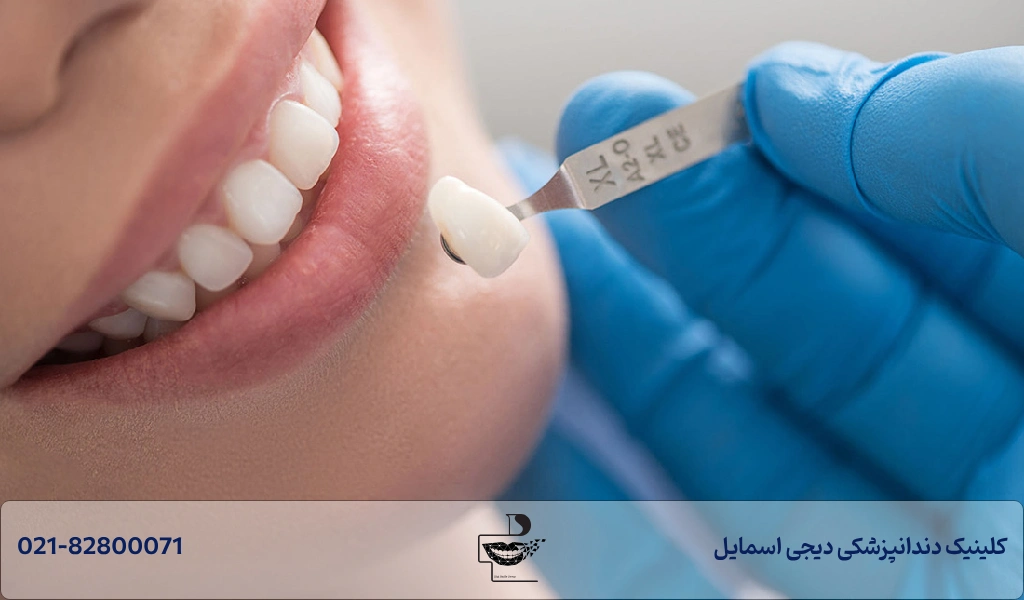 کامپوزیت و لمینت چه تفاوت هایی دارند؟