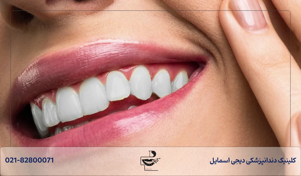 تفاوت لمینت و کامپوزیت دندان در ظاهر و شفافیت