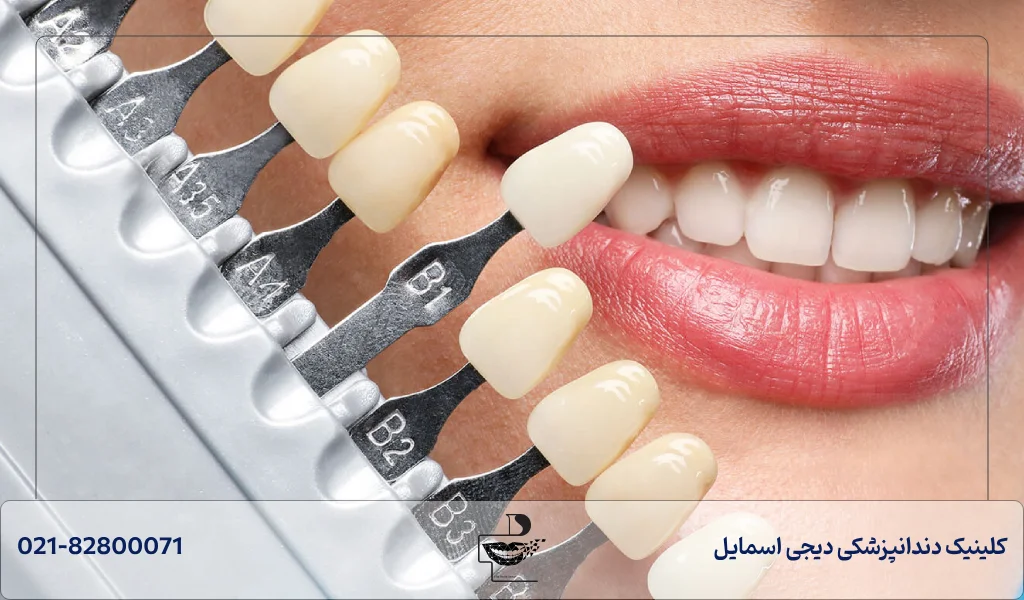 فرق کاربرد لمینت و کامپوزیت دندان