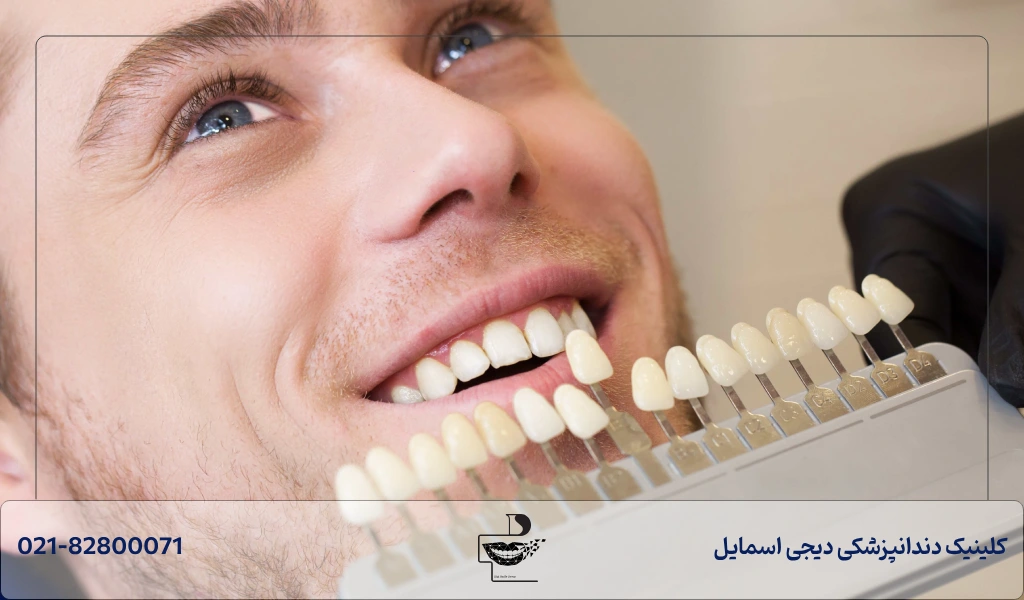 تغییر رنگ و پوسیدگی دندان از مهم ترین مضرات کامپوزیت برای دندان