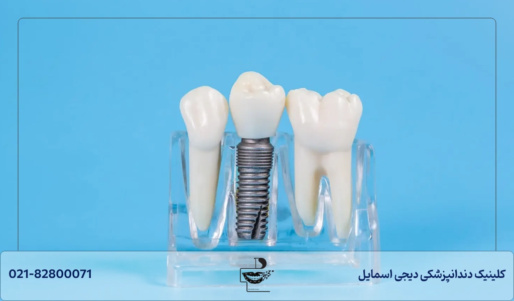 عمر مفید ایمپلنت دندان براساس کشور سازنده؛ عمر ایمپلنت کره ای، ایرانی و امریکایی