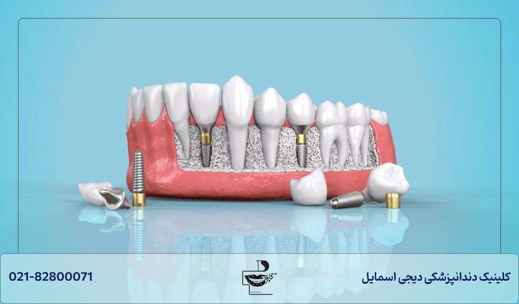 طول عمر ایمپلنت دندان ایرانی، کره ای،سویسی و امریکایی