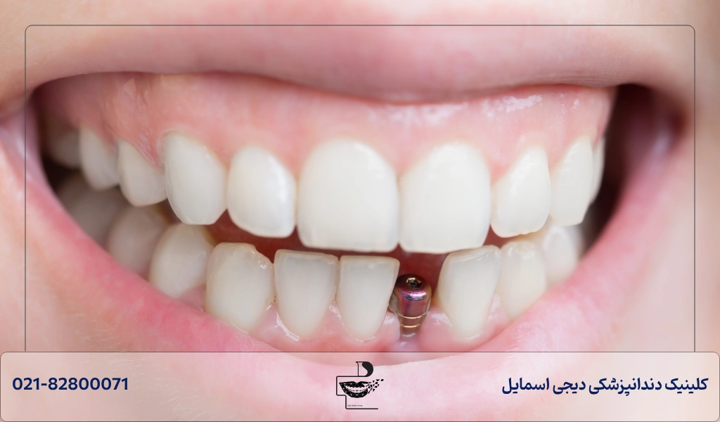 چه عواملی باعث کاهش طول عمر ایمپلنت دندان می شود + راه های افزایش عمر ایمپلنت دندان
