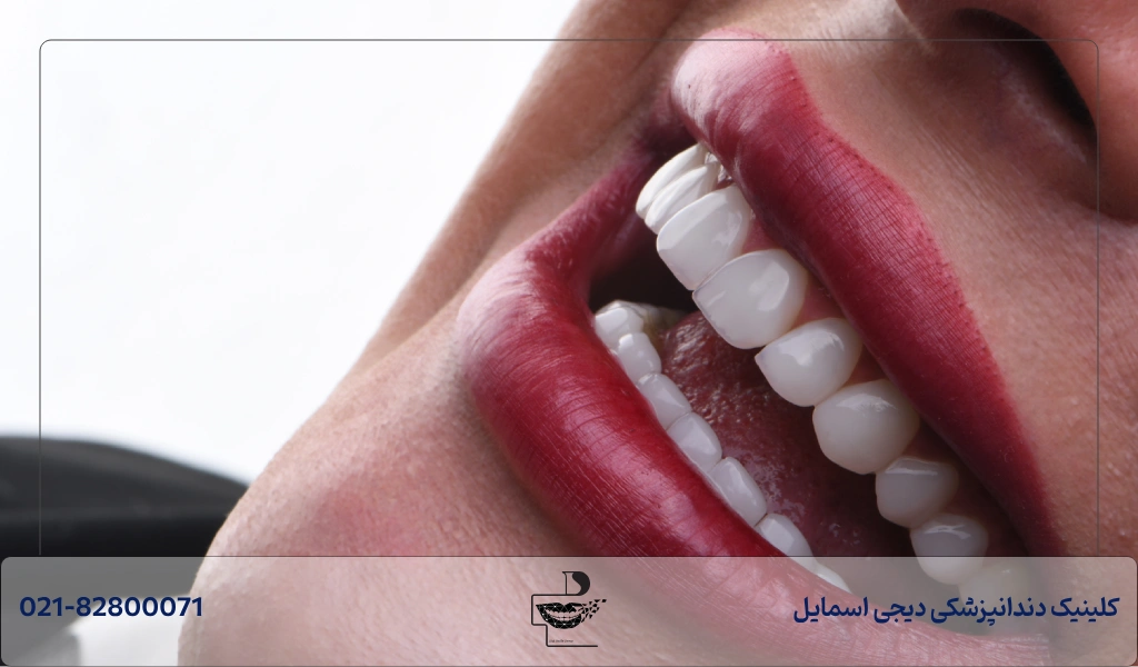 بهترین دکتر لمینت در شمال تهران